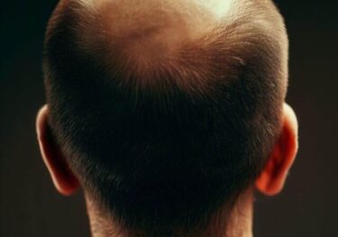 男性型脱毛症（AGA）とは何かを知る：遺伝から環境要因まで、全方位的な解説と対策